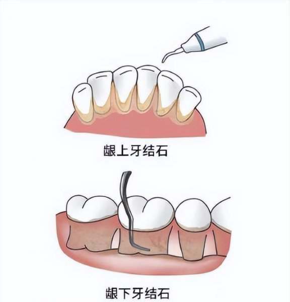 牙结石洗牙多少钱