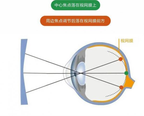 离焦镜片和普通镜片的眼镜的区别