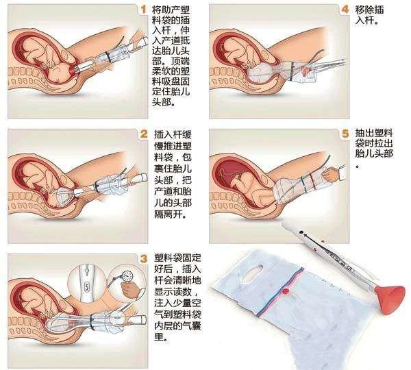 人生最后悔就是顺产