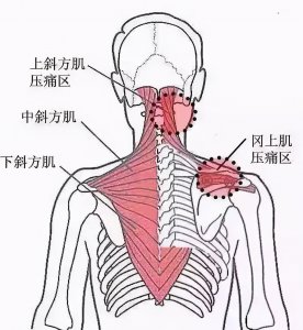 肩膀厚有什么办法改善 肩宽背厚脖子短可以怎么锻炼