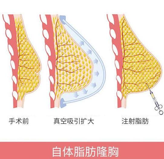 隆胸的后遗症有哪些？危害大不大