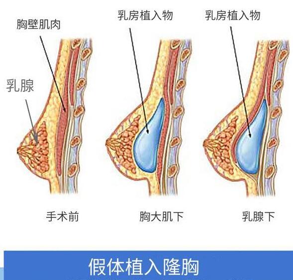 隆胸的后遗症有哪些？危害大不大