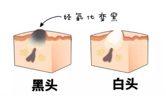 鼻子上的黑头直接挤掉可以吗