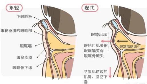 眼霜可以去眼袋的作用吗