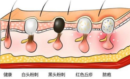 黑头粉刺怎么形成的