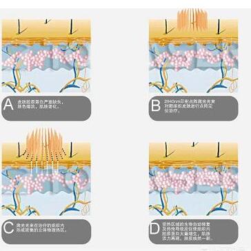 脸上起痘痘是什么原因？