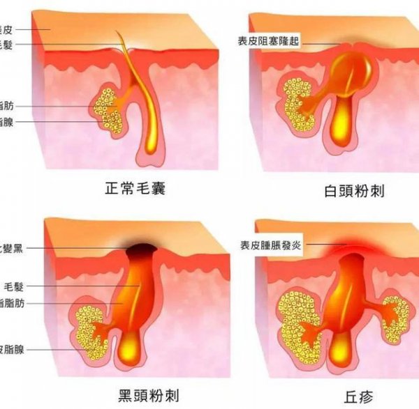 为什么黑头总是去不掉