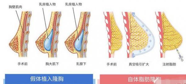 隆胸都是什么填充物？