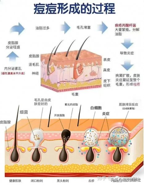 皮肤出油长痘怎么办