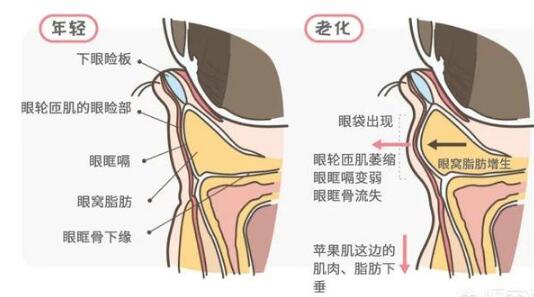 眼袋怎么消除简单方法有哪些