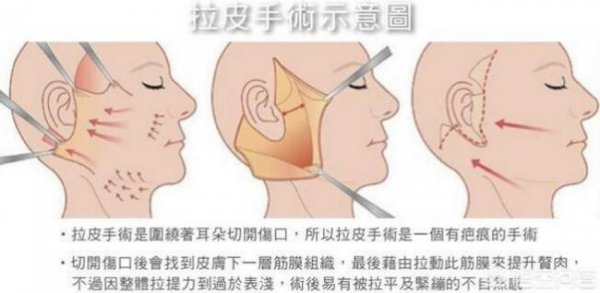 眼睛有皱纹该怎么办消除的方法？