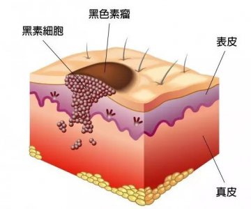 脸上黑色素怎么代谢出来 脸上底层的黑色素怎么代谢掉