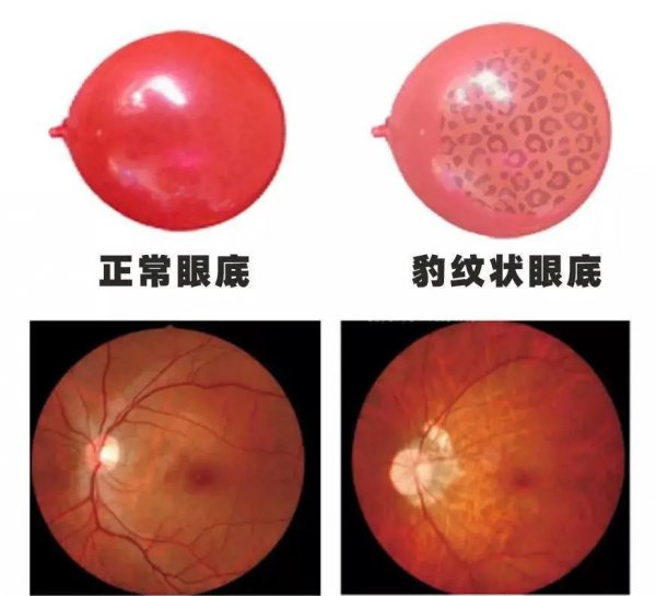 成年后近视度数还会加深吗