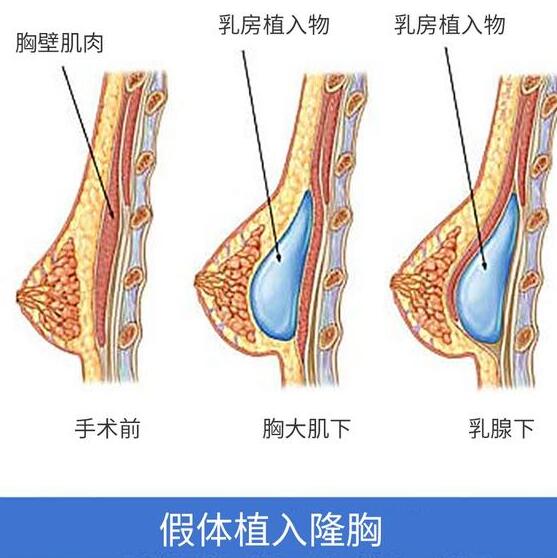 假体隆胸的危害有哪些？