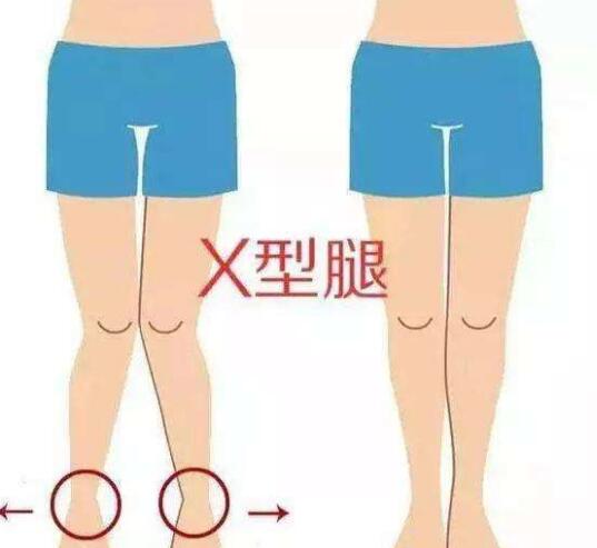 x型腿怎么矫正的方法？