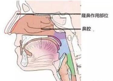 有鼻炎的人能隆鼻吗